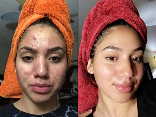 Eloria Rice Peel Serum Ampoule™